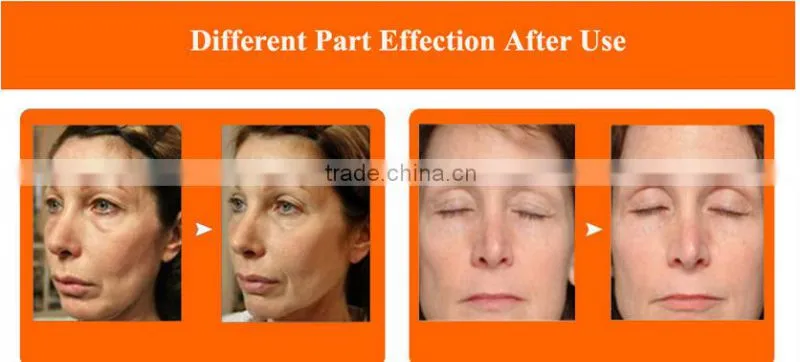 5MHZ RF for face lifting and skin tightening beauty instrument