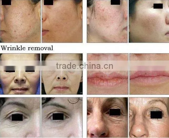 2011 CO2 Fractional Laser Machine for skin rejuvenation and wrinkle removal
