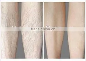 Wanted Distributor permanent hair removal for men machine home use