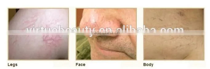 portable Lipolysis Laser Melting fat equipment with 30W 980nm diode laser