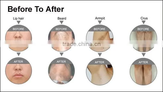 Hot selling aft Fashion handles SHR IPL/IPL SHR/IPL machine