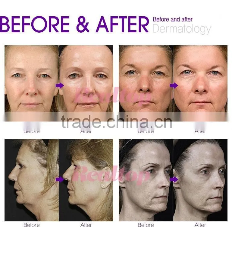 Cryo Pdt SRF MRF Skin Care RF Fractional Micro Needle Machine CPT Microneedling Korea Equipments Producing