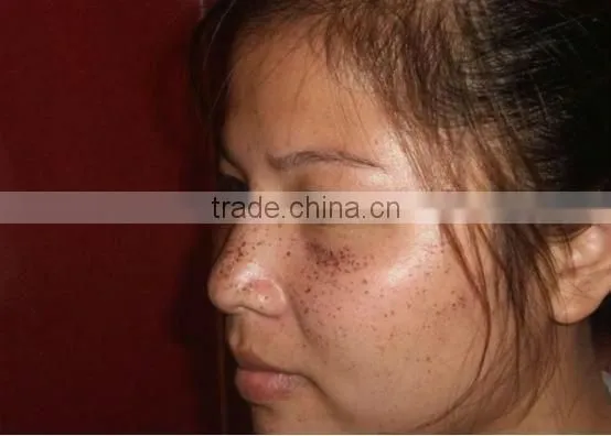 IPL RF Laser beauty equipment