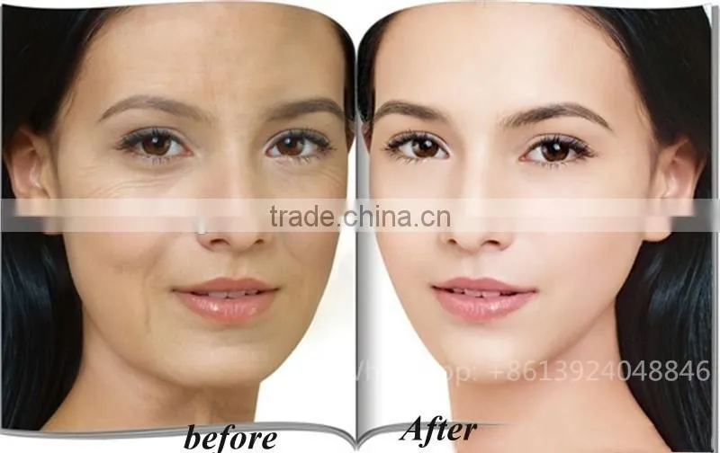 1550nm Anti-Aging Laser Stretch Marks Elimination Rejuvenation Therapy Machine 1550nm laser fiber laser machine