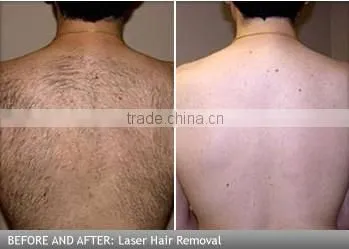 Good depilacion laser nd yag laser spider vein removal machine in hot sale