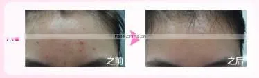 Laser skin machine hair removal device for permanent hair removal skin rejuvenation and acne clearance with 3 lamps