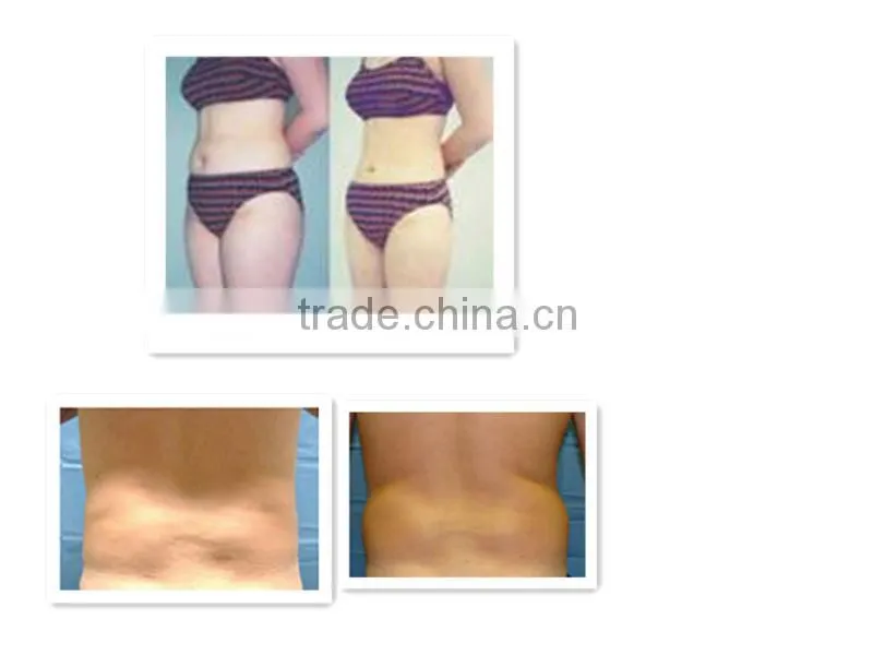 non-surgical liposuction machines