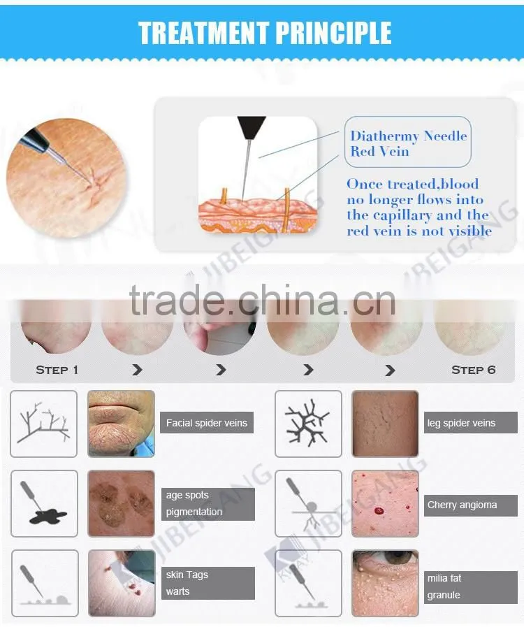 CE approved high frequency 30 MHz RBS laser spider vein removal machine for sale