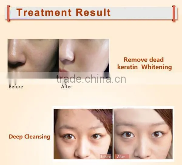 wholesale Facial Skin Scrubber Salon Spa Ultrasonic Skin Care device