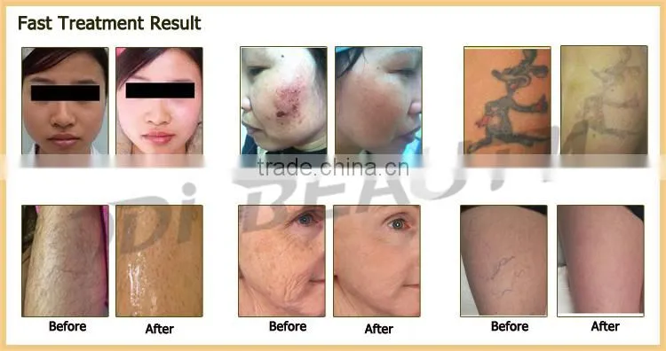 (CE)Great nd yag laser + ipl and rf machine with 10 HZ Laser + OPT IPL
