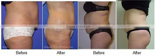 Eyelid area treatment cellulite reduction ultrasound vacuum cavitation rf machine