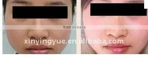 laser tattoo removal q switch nd yag laser