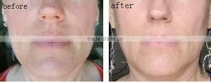 Best quality mini face tightening cold hammer with blue light for skin rejuvenation
