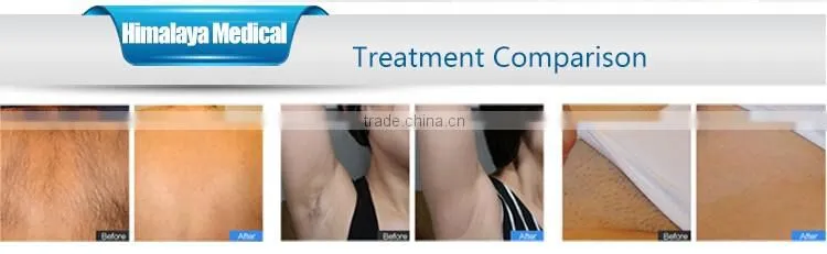 2016 high quality epilation facial laser hair removal machine
