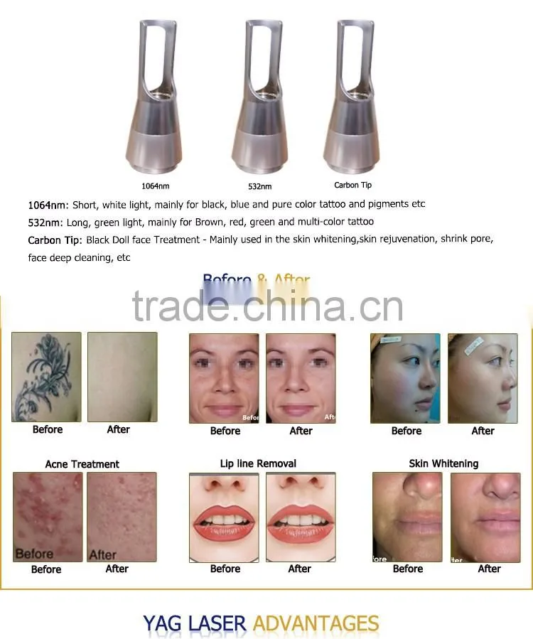 Portable nd yag machine 532 1064 laser for removing tattoo and spots