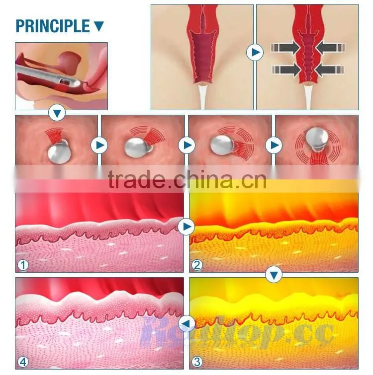 skin resurfacing vaginal tightening laser equipment co2 fractional beauty salon instrument for sale vaginal tightening device