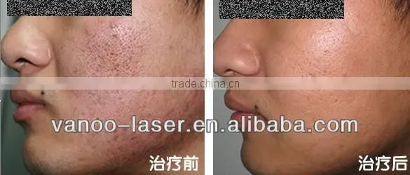 PDT LED red/blue/yellow/infrared led light skin rejuvenation