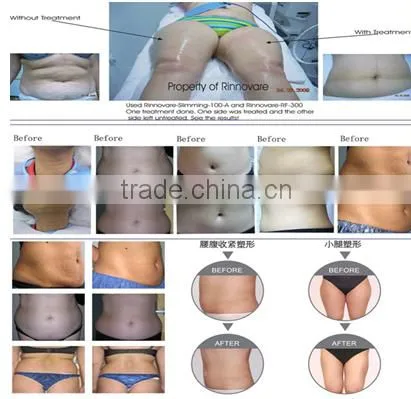 Vacuum body massager anti cellulite suction machine radiofrequency machine