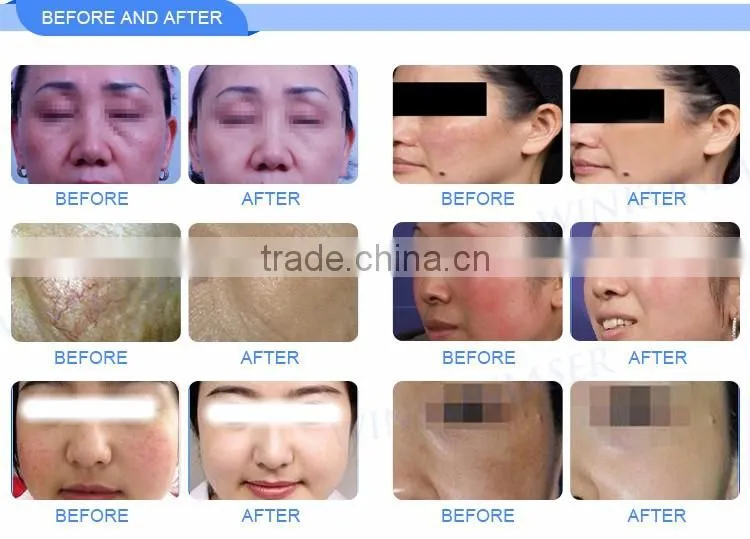 Wholesale OEM ODM approved leg legs care varicose spider vein treatment cream natural method