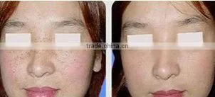 Manufacture Supplied Portable Hair Removal IPL Machine