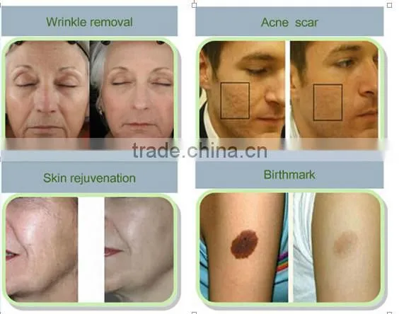 co2 fractional rf vaginal tightening co2 laser surgery machine