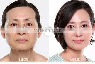 2015 New Arrival Monopolar RF Radio Frequency Tighten Wrinkle