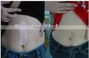 epidermis transplantation vitiligo machine