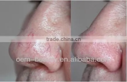 Salon equipment laser hair removal for sale