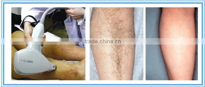beauty salon equipment laser hair removal machine