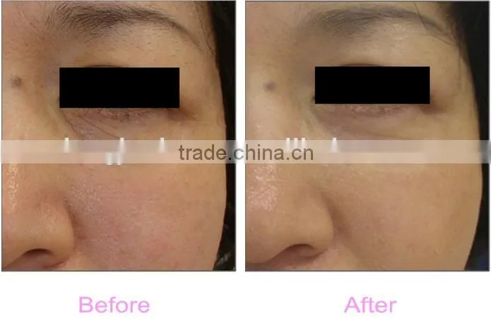 multifunctional jet peel machine skin rejuvenation Oxygen jet peel beauty equipment