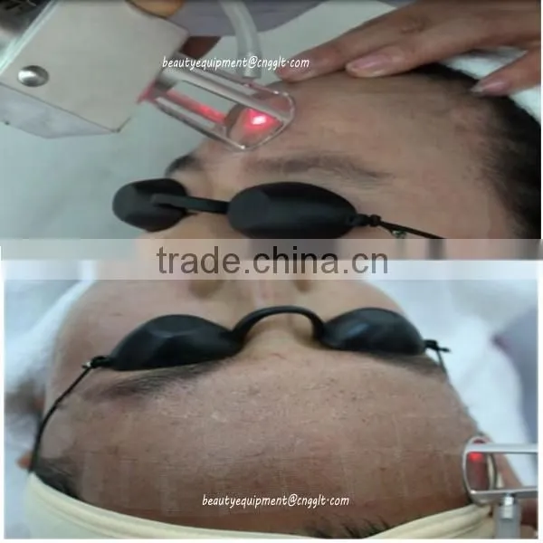 High qaulity glass co2 laser skin tag removal machine