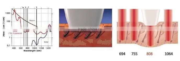 Safe And Effective Portable 808 Diode Laser Treatment For Unwanted Hair Removal From Face By Laser