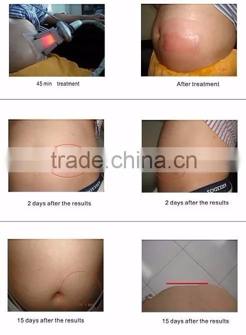 Body slimming fat freezing cavitation cryo lipo machine