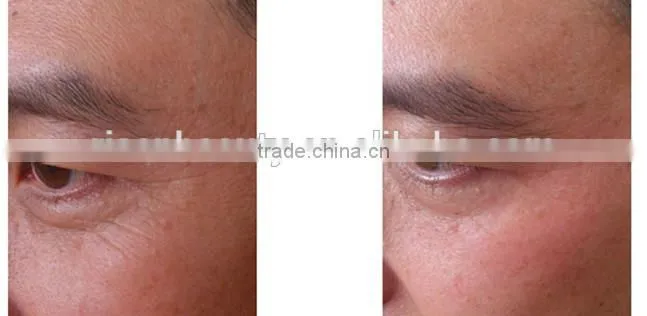 Professional Face Lift Beauty Equipment Multipolar Fractional RF