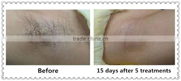 Allfond upper lip hair removal machine