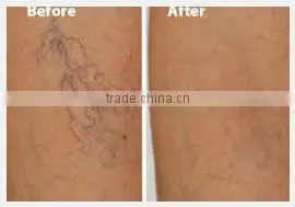 factory price best beauty device / facial veins removal / varicose vein treatment equipment