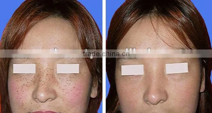 black spot remover cheap ipl hair removal scar treatment