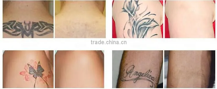 Stationary Style and 1064 nm 532nm Q-Switch laser pigment