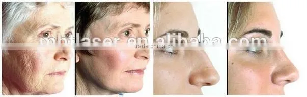 Professional Portable Rf Wrinkle Removal Equipment Sikn Lift For Scalp Care