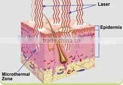 new hot professional Rhytidectomy Fraction new face dead skin remove