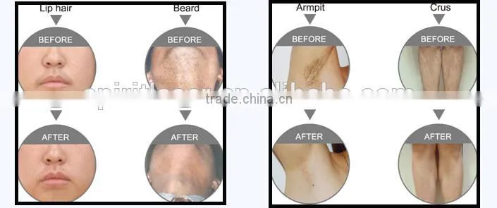 diode laser 808 / diode laser 808nm / diode laser 808nm hair removal