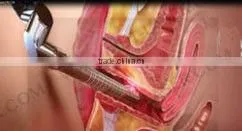 rf co2 fractional laser