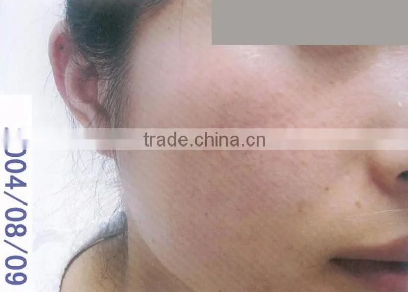 acne removal beauty device elight beauty beauty salon devices