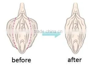 medical vaginal tightening co2 laser machine