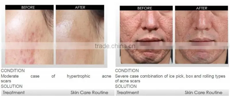 540 derma roller