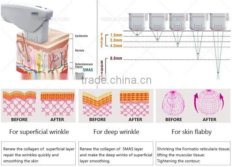 High Frequency Operation System and Anti-Puffiness/Skin Tightening/Wrinkle Remover Feature HIFU Face Lift
