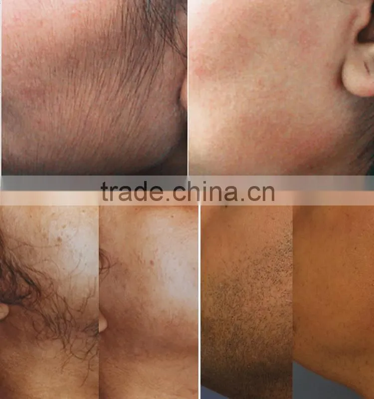 Elight IPL SHR quick removal laser machine tightening skin