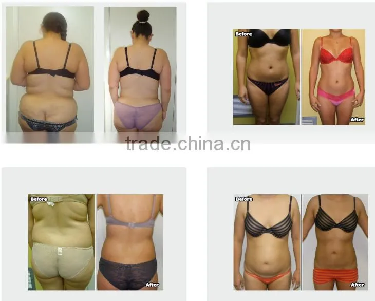 Osano Shape vacuum slimming machine for sale