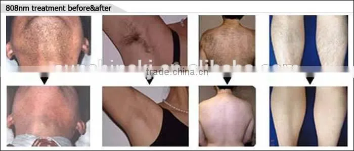 permanent hair removal machine for body beard and armpit hair