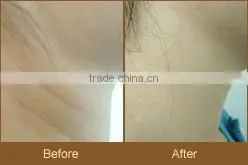 2015 Newest multifunctional cosmetic equipment ipl hair removal germany skin solution